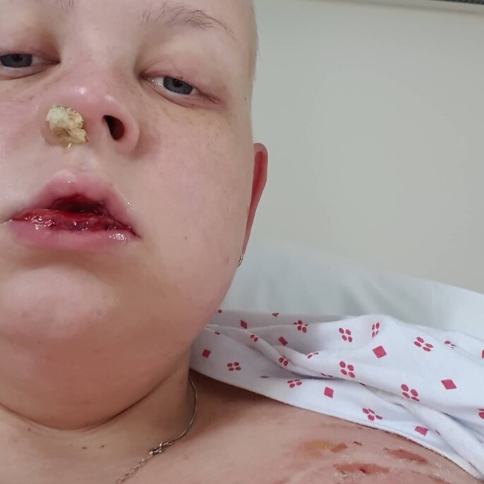 Lena ble alvorlig syk av cellegifta Lena ble alvorlig syk av cellegifta